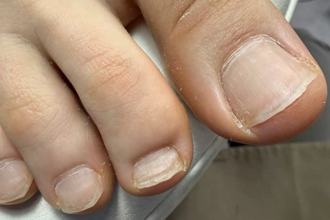 Before Swiss Pedicare foot care treatment