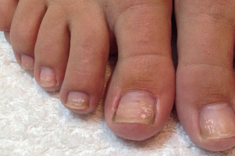 Before Swiss Pedicare foot care treatment