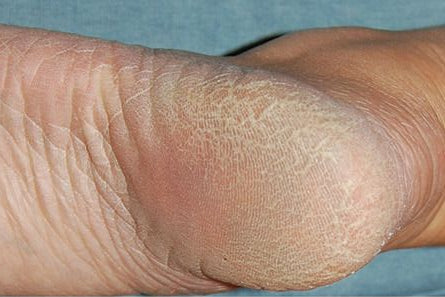 Before Swiss Pedicare foot care treatment